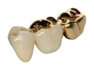 gold teeth best